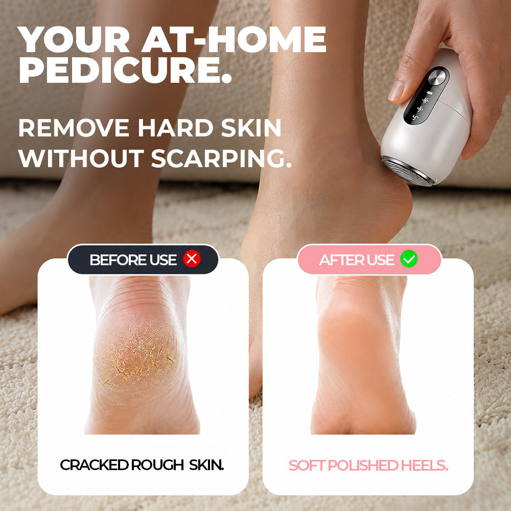 GlowShaver® Electric Foot Callus Remover